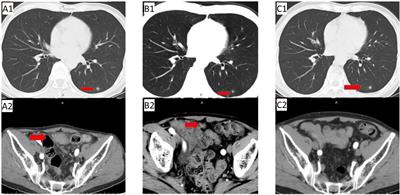 Anlotinib combined with TAS-102 as the third-line treatment for a patient with metastatic colon cancer: A case report